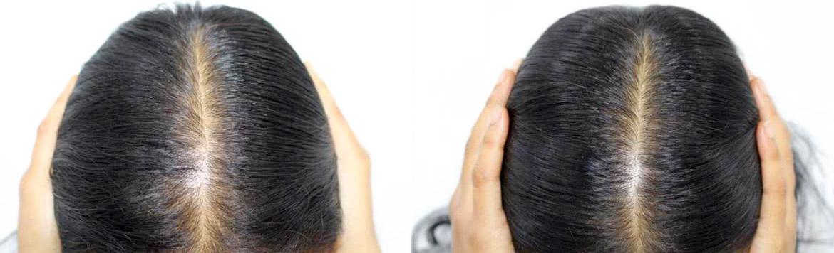 Trattamento dei capelli